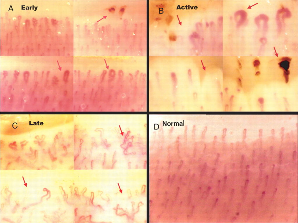 Nail Fold Capillaries