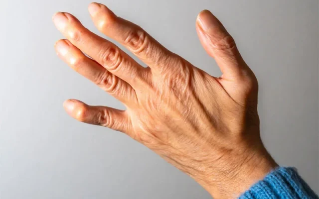 When to suspect RHEUMATOID ARTHRITIS (RA)? WHAT ARE THE EARLY SYMPTOMS?